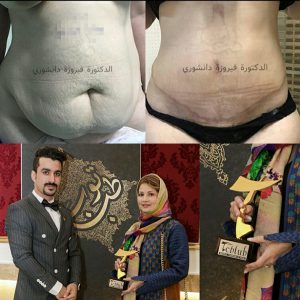 عملية شفط الدهون في ايران