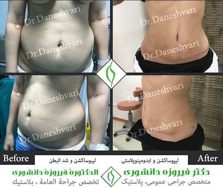 شفط الدهون في ايران