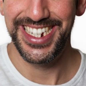 زراعة الاسنان الامامية
