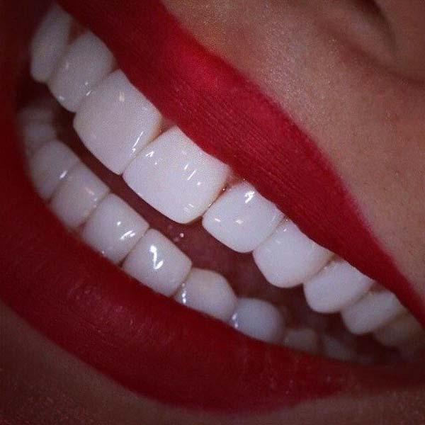 طريقة عمل ابتسامة هوليود بالفيديو و انواع ابتسامة هوليود في ايران لومينير الاسنان و فينير الاسنان