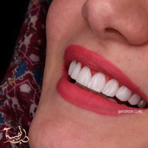 فينير الاسنان بدون برد قبل و بعد في ايران