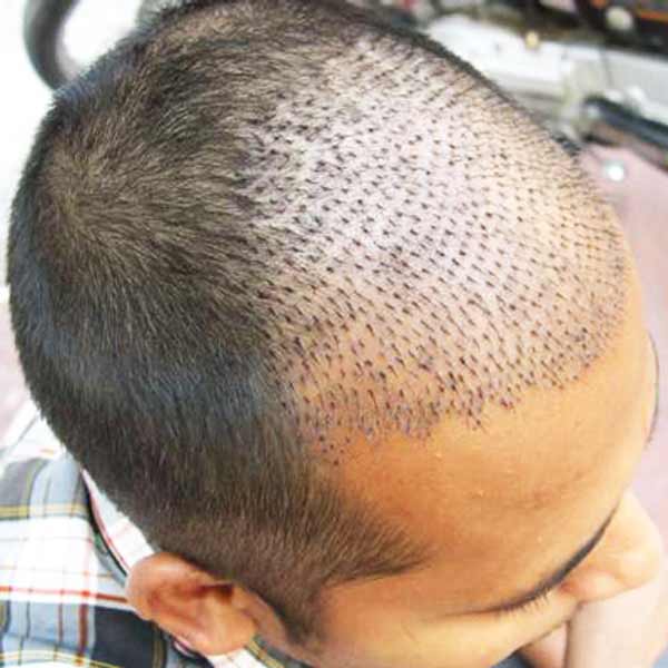 زراعة الشعر طريقة sut في ايران