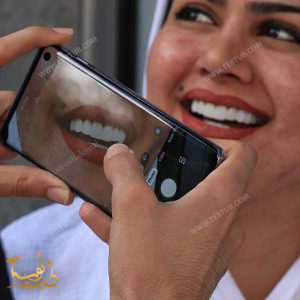 فينير الاسنان الثابت في ايران