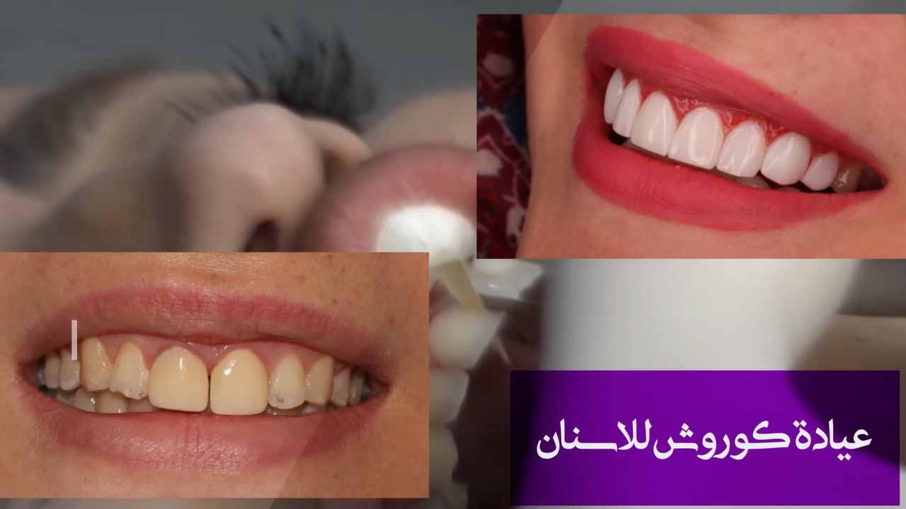 تجميل الاسنان في ايران