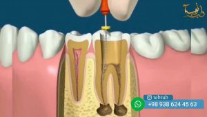 علاج العصب الاسنان