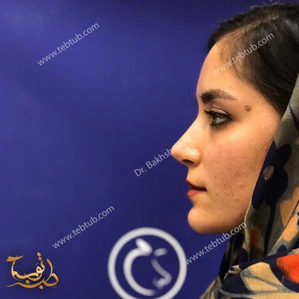 التجميل الانف في ايران