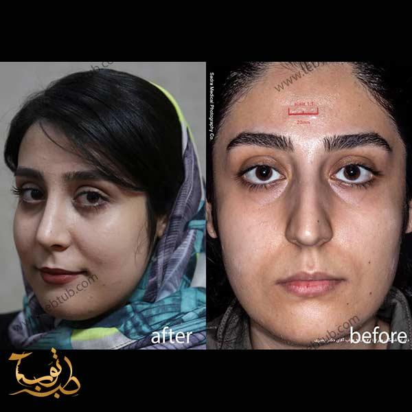 قبل وبعد عمليات التجميل الانف في ايران
